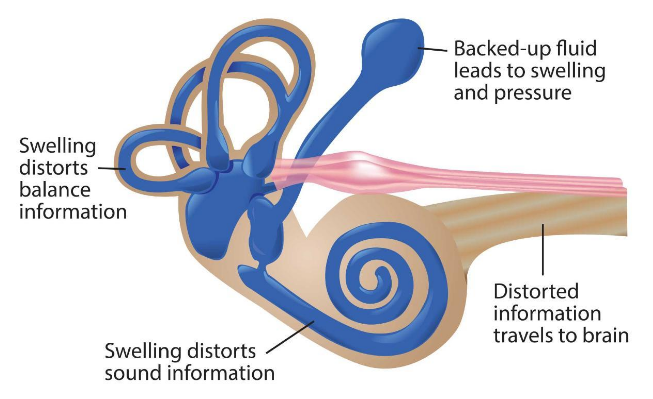 diagram of inner ear when swelling occurs