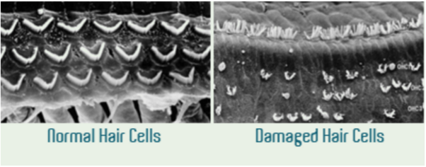 magnified comparison of normal hair cells and damaged hair cells