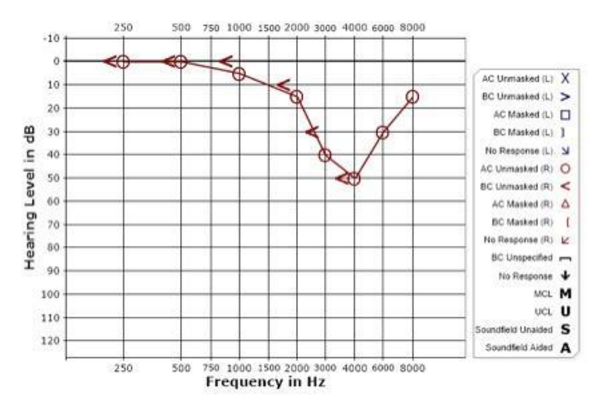 hearing test showing hearing loss at 4000 Hz