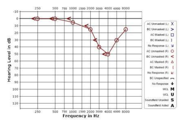 Inner Ear Disorders And Hearing Loss Hearing Healthcare Centers