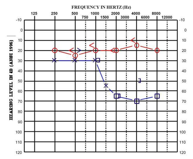 audiogram of sudden hearing loss