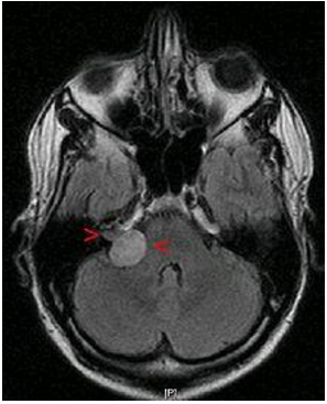 MRI showing acoustic neuroma